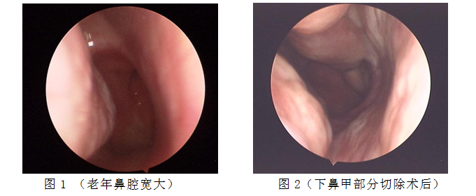 老年鼻腔宽大