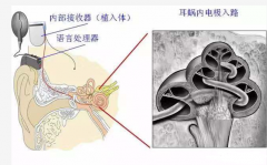 一篇掌握<人工耳蜗>那些事儿