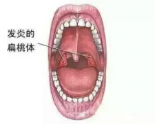 扁桃体术后需要注意些什么呢